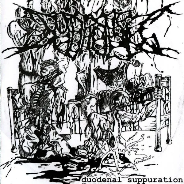 Hydropsy – Duodenal Suppuration