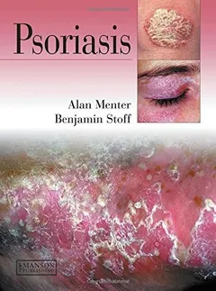 Psoriasis by Alan Menter